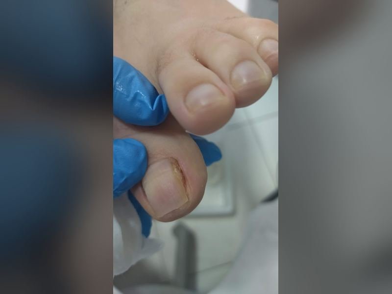 Avaliação de uma unha do pé antes do início do procedimento