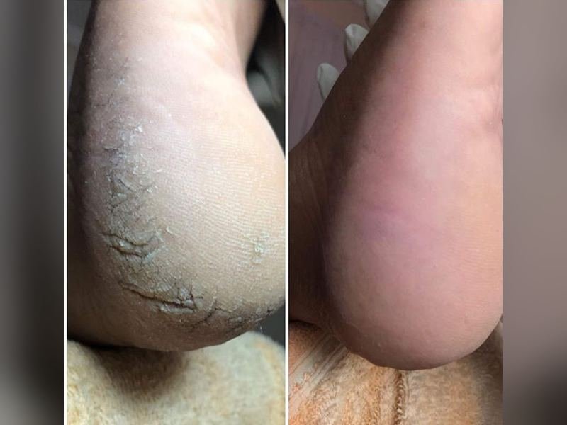 Comparativo antes e depois de rachaduras no calcanhar tratadas com hidratação profunda