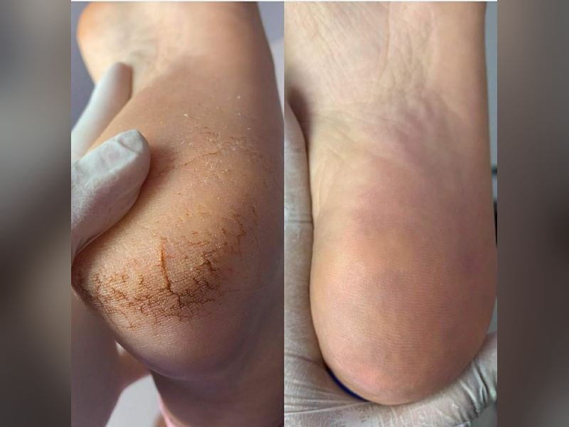 Comparativo antes e depois de um calcanhar com rachaduras profundas