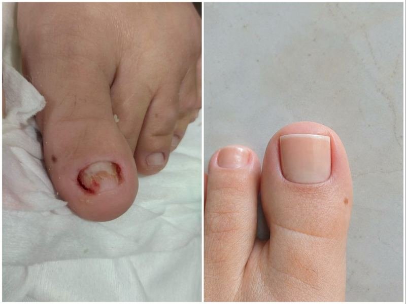 Comparativo antes e depois de uma unha do pé recuperada