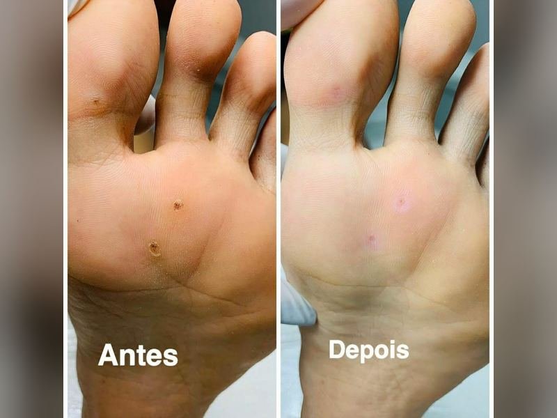 Comparativo antes e depois do tratamento de verruga plantar na sola do pé